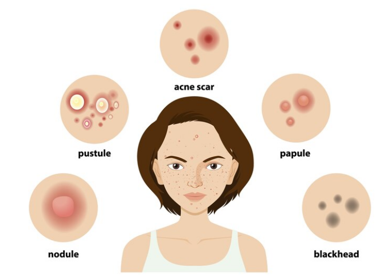 ما هي أعراض حب الشباب؟